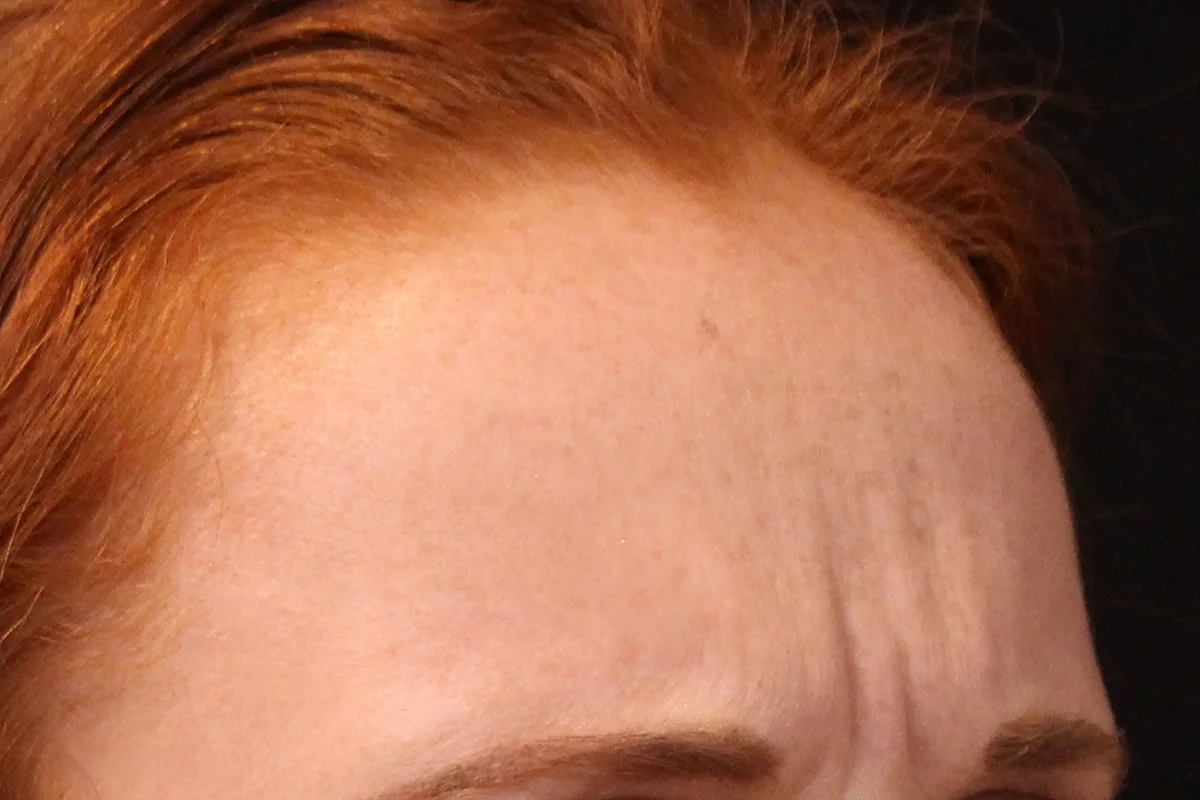 Young woman before Botox