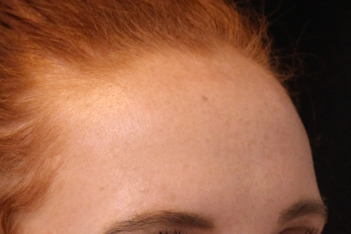 Young woman after Botox