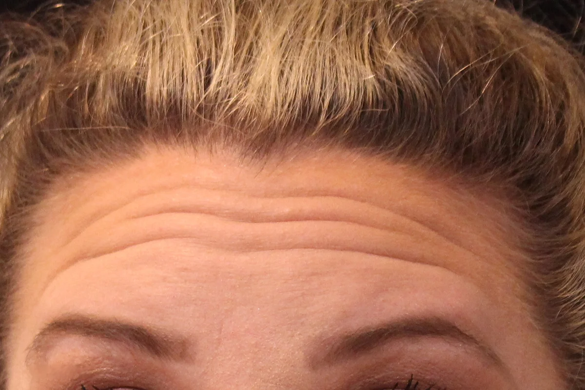 Middle-aged woman before Botox