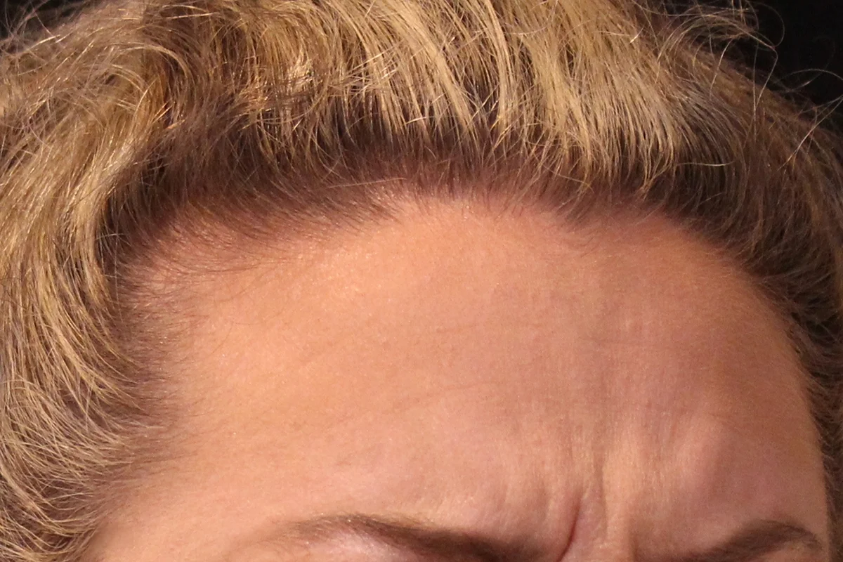 Middle-aged woman before Botox