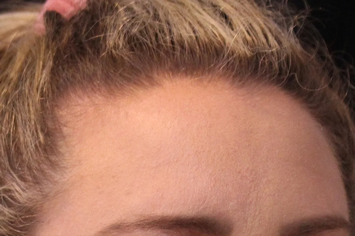 Middle-aged woman after Botox