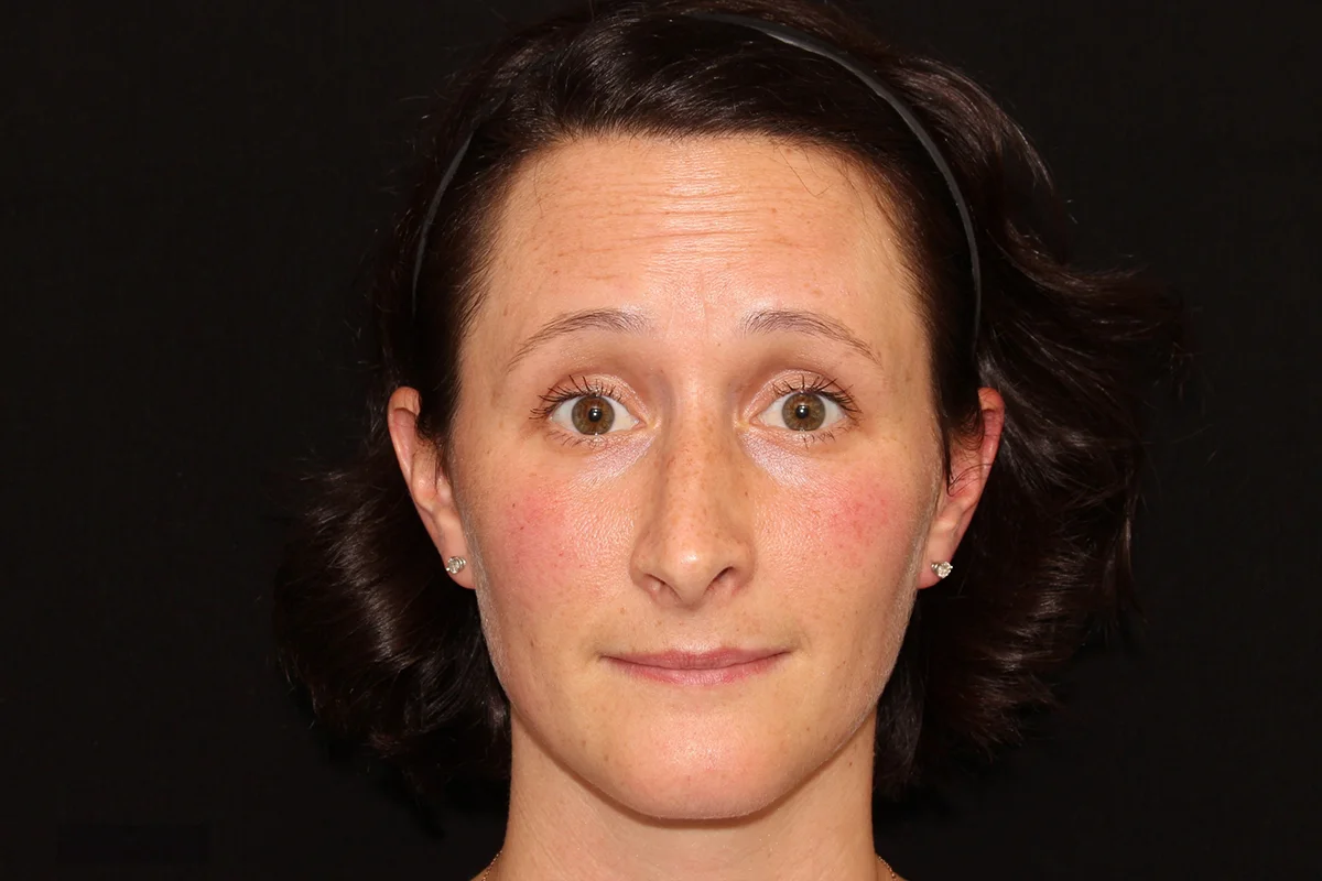 Young woman before Botox
