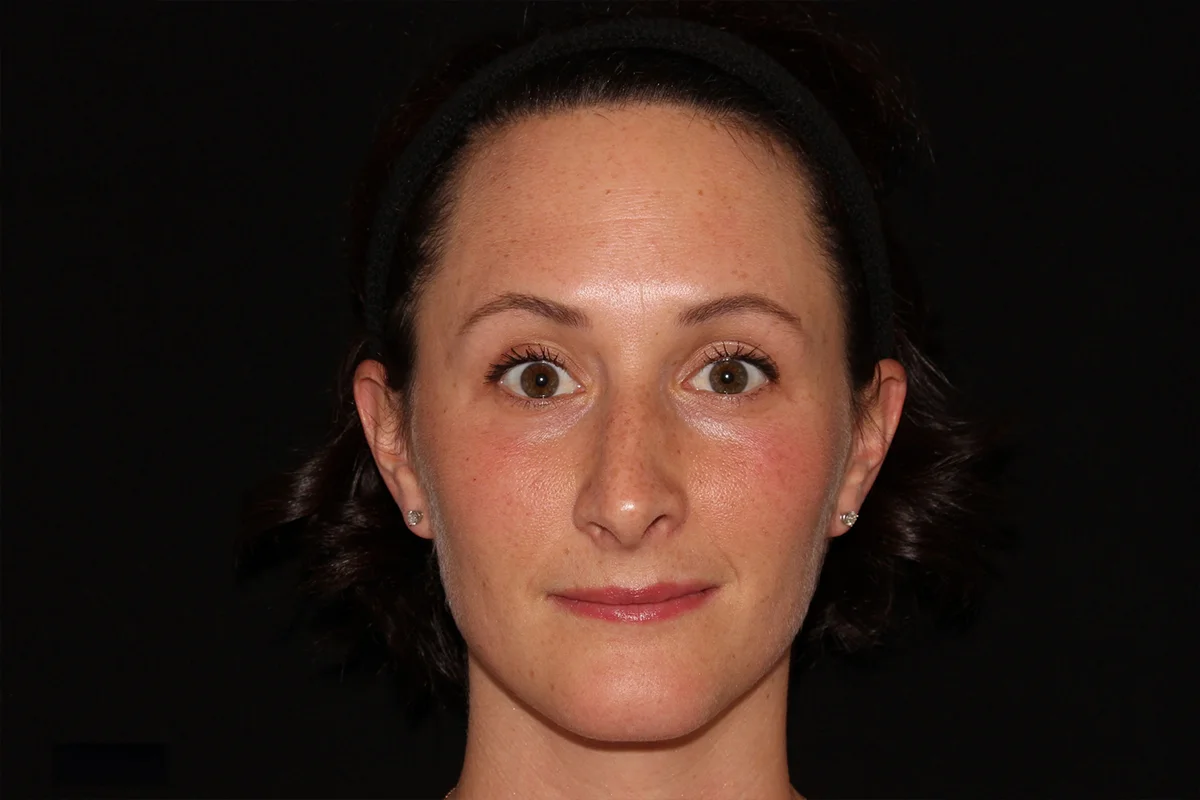 Young woman after Botox