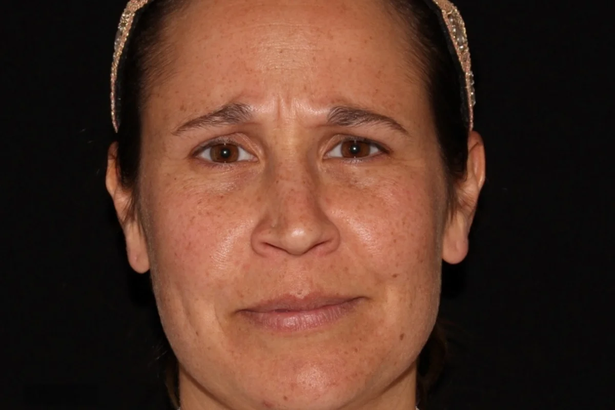 Middle-aged woman before Botox