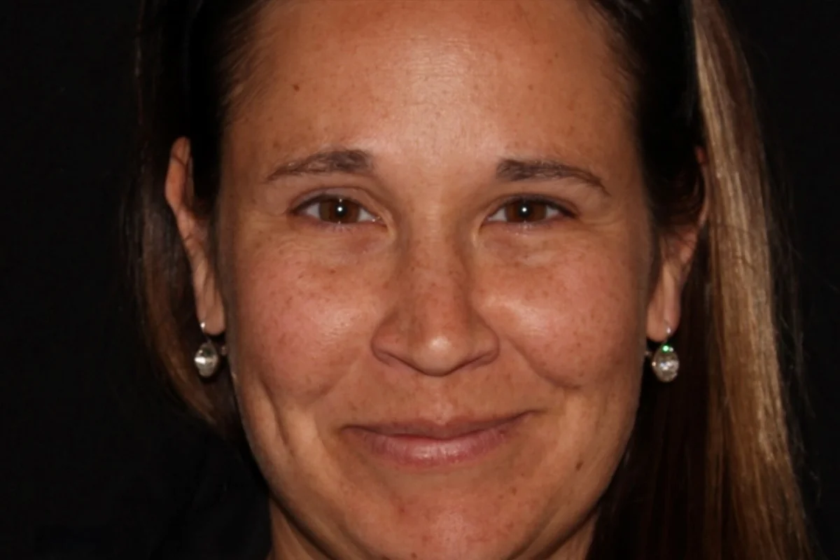 Middle-aged woman after Botox