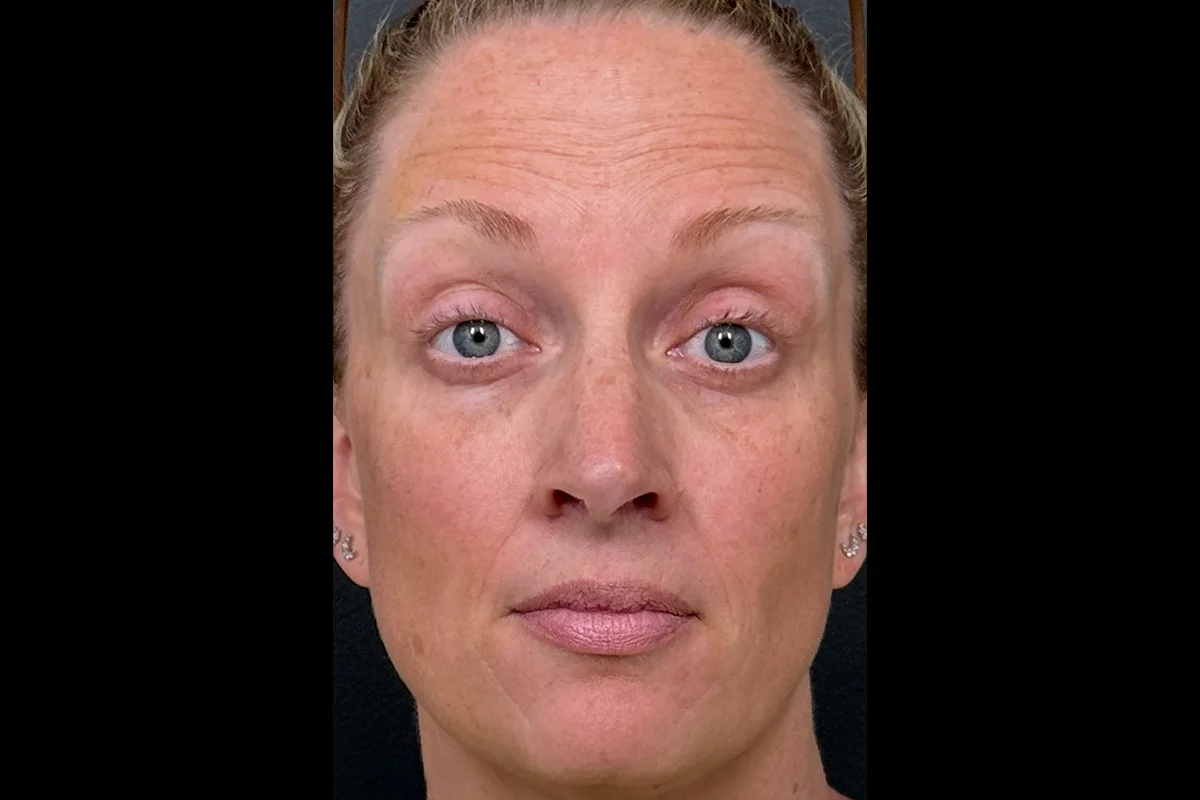 Middle-aged woman before Botox