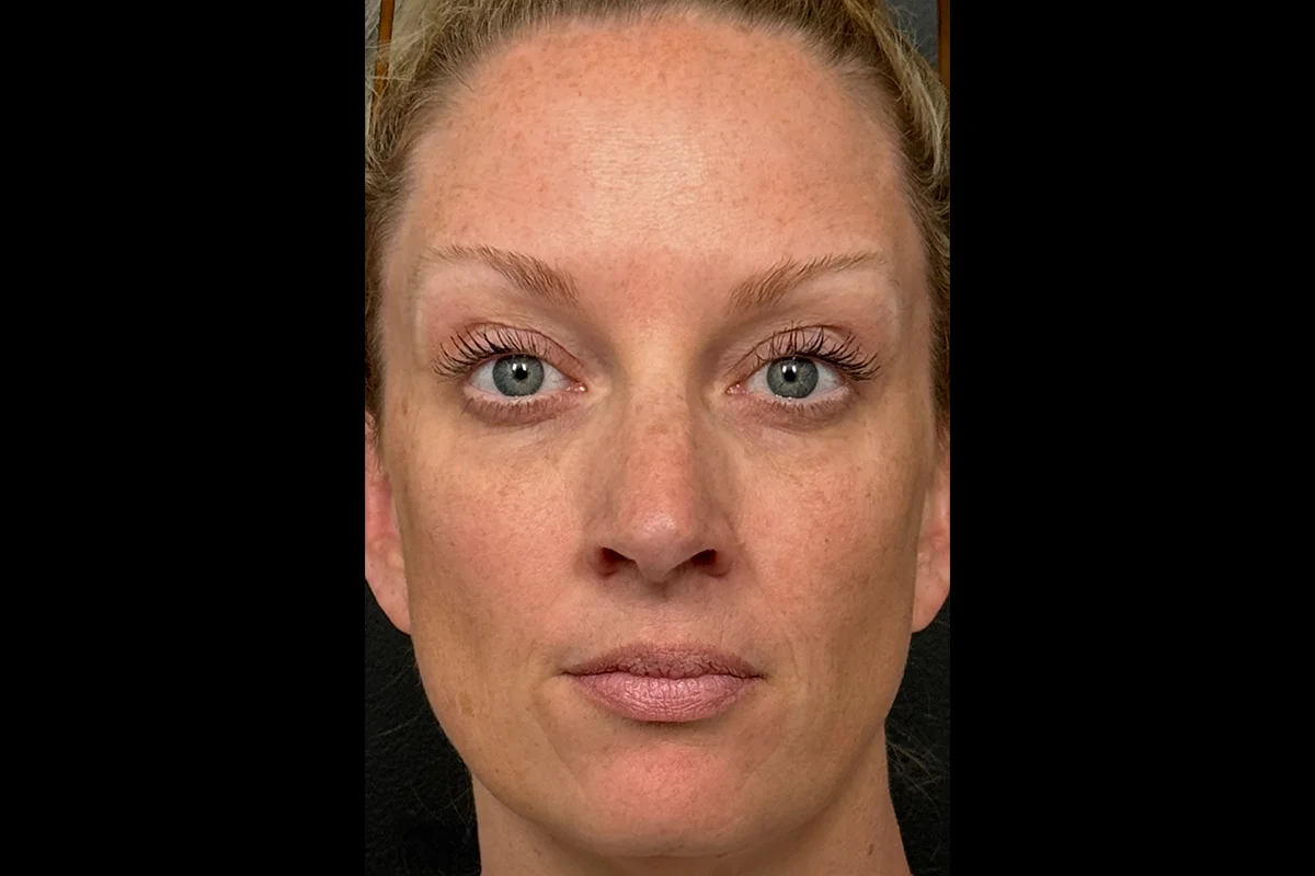 Middle-aged woman after Botox