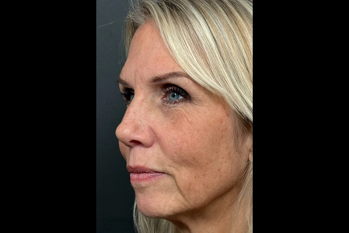 Middle-aged woman before facial filler