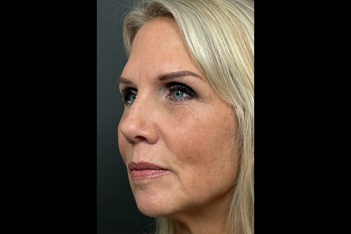 Middle-aged woman after facial filler