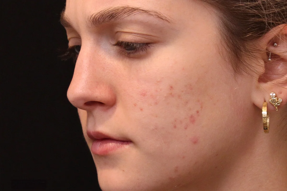 Young woman before microneedling