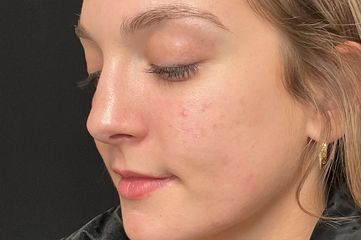 Young woman after microneedling