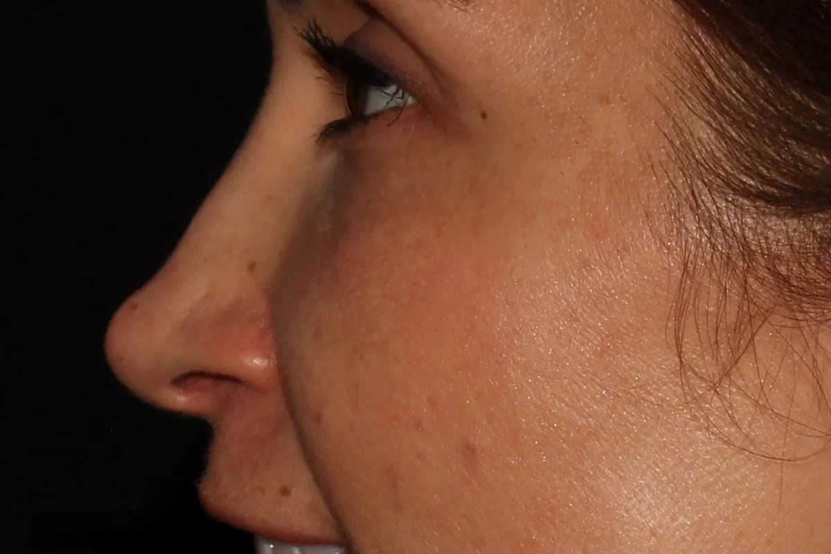 Young woman before liquid rhinoplasty