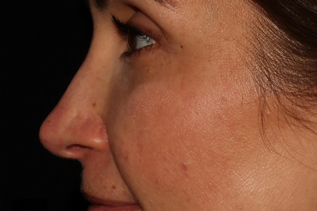 Young woman after liquid rhinoplasty 