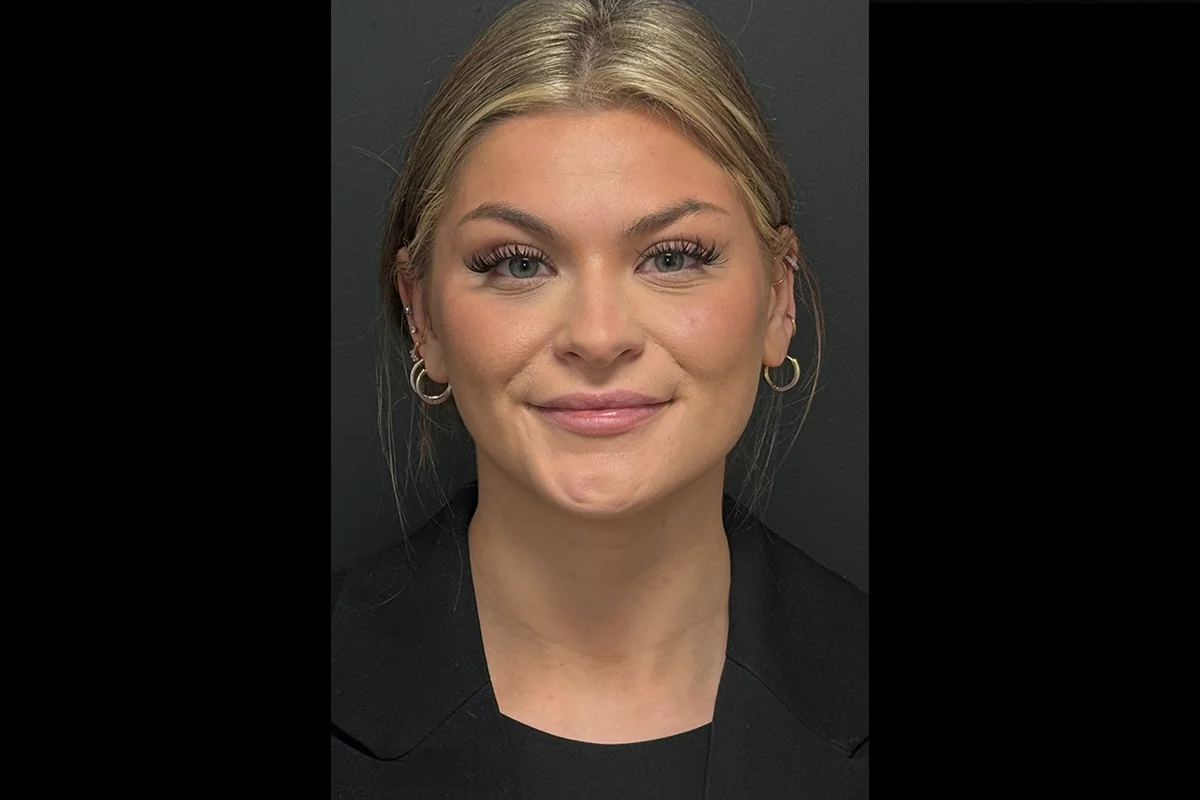 Young woman before lip filler