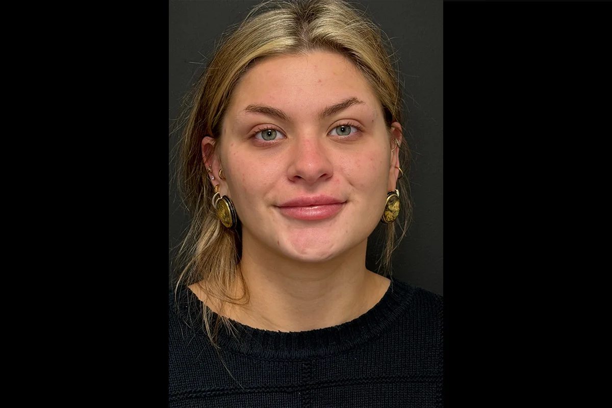 Young woman after lip filler