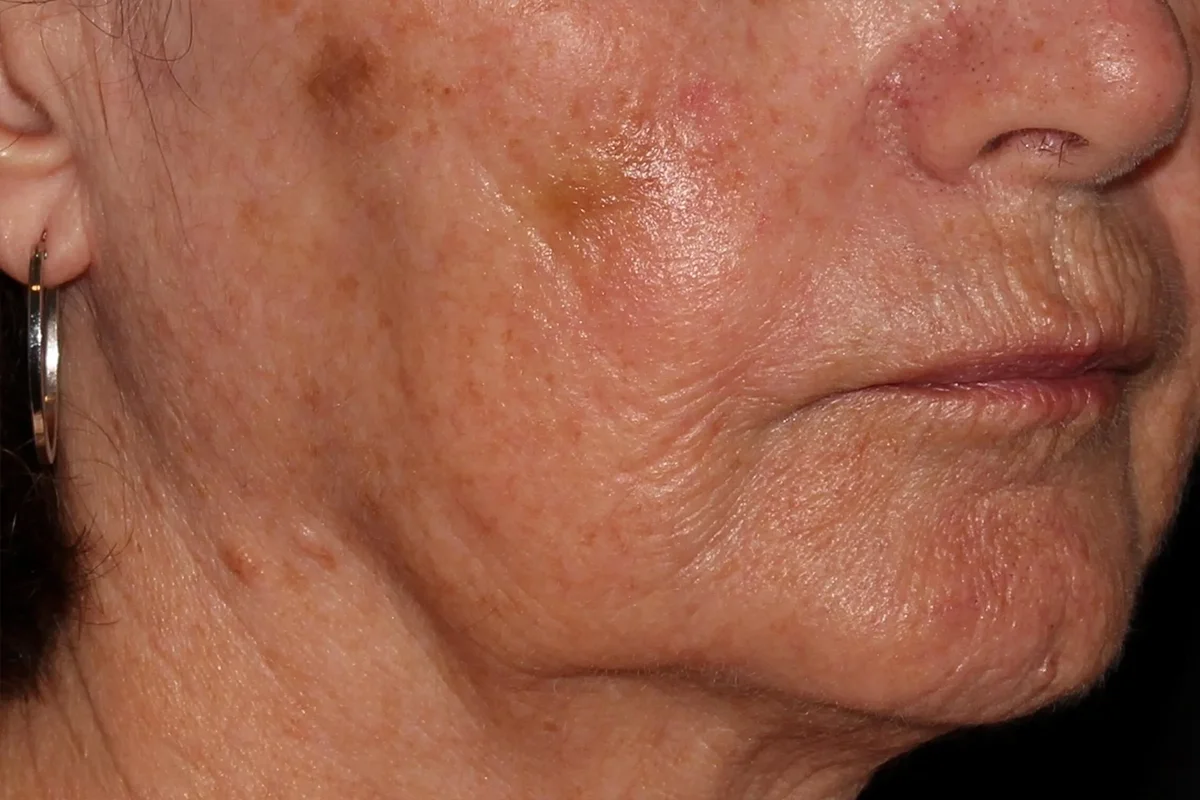 Older woman before TCA Chemical Peel