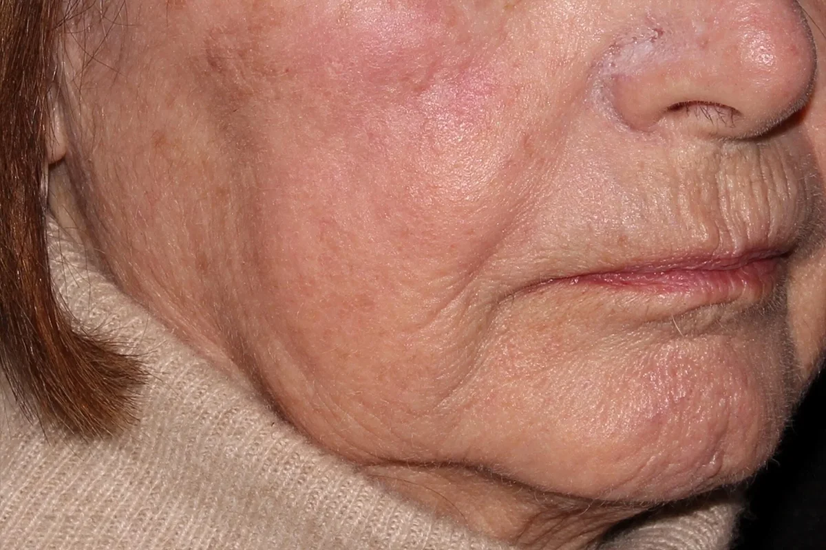 Older woman after TCA Chemical Peel 