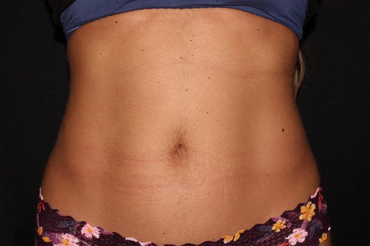 Young woman before CoolSculpting