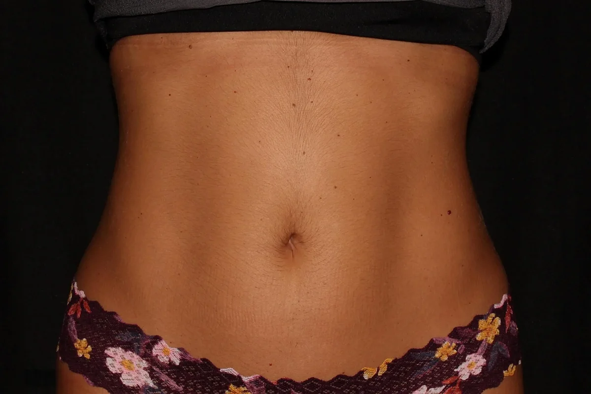 Young woman after CoolSculpting