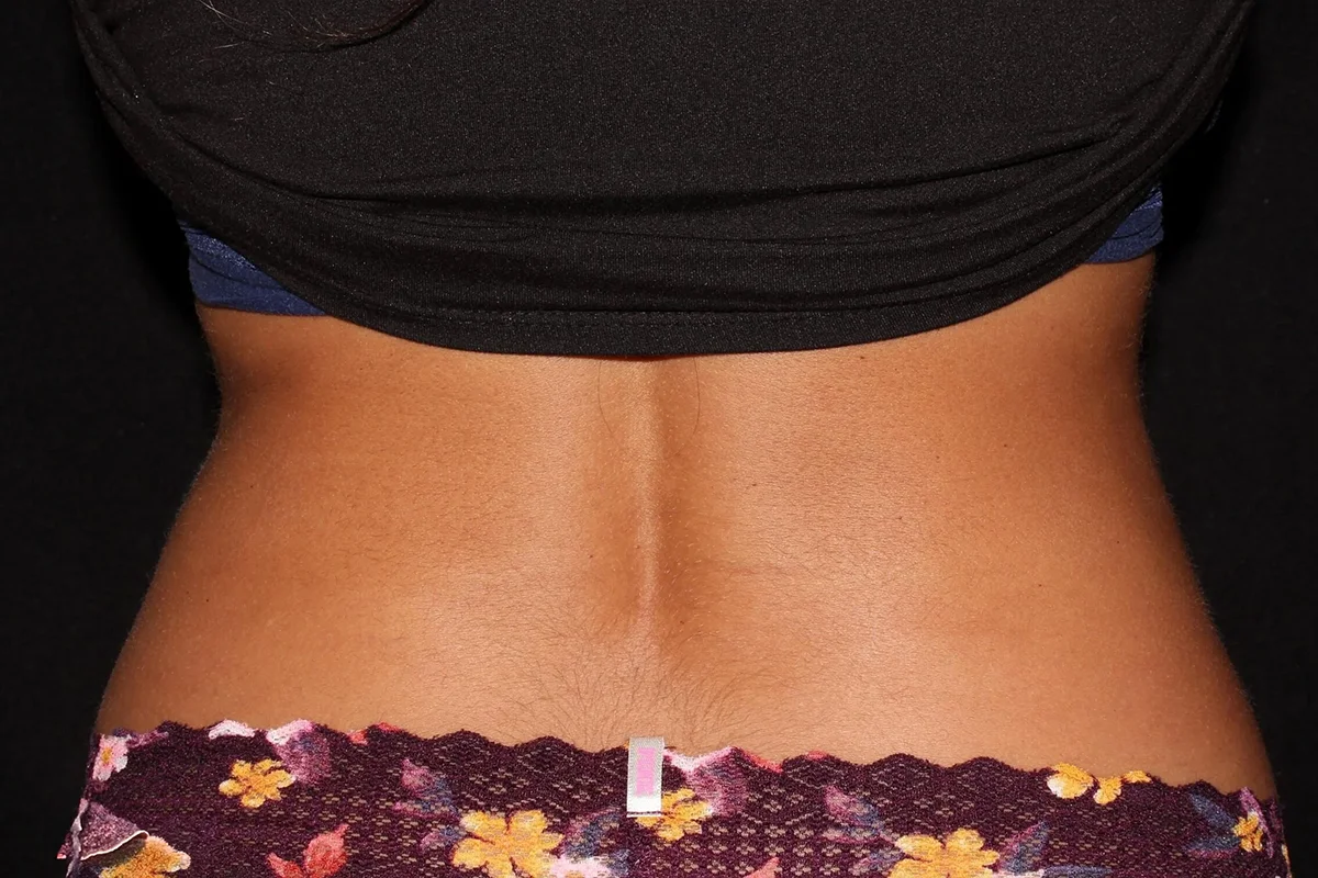 Young woman before CoolSculpting