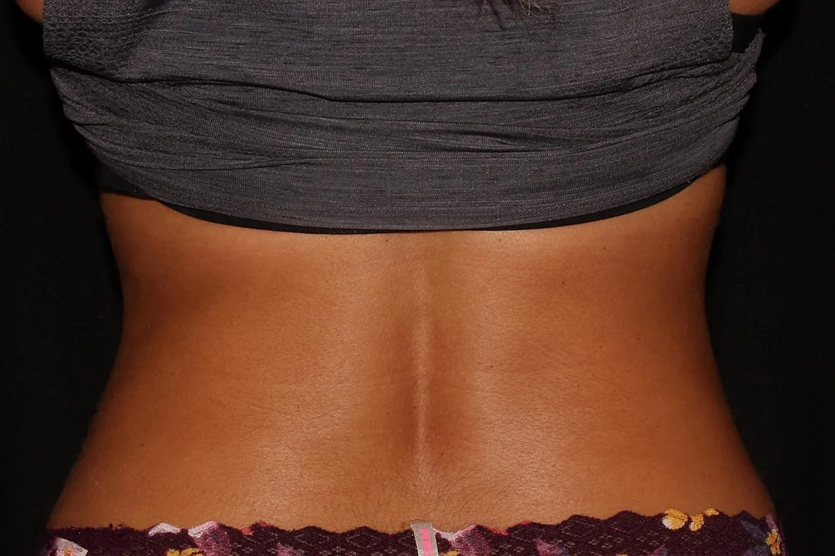 Young woman after CoolSculpting