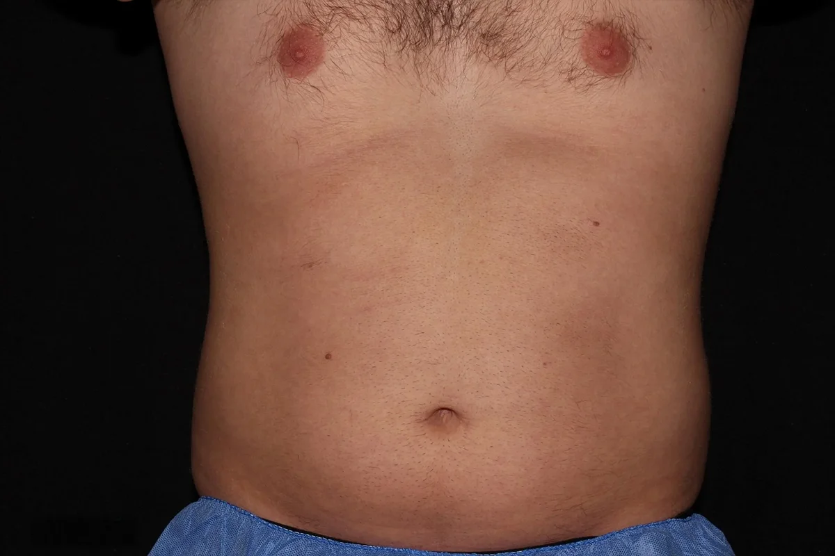 Middle-aged man before CoolSculping
