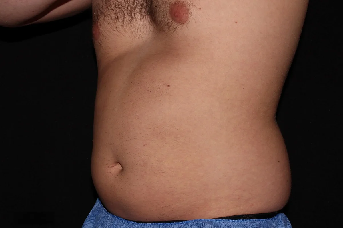 Middle-aged man before CoolSculping