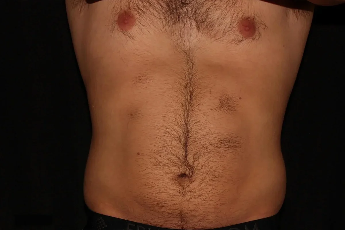 Middle-aged man after CoolSculpting