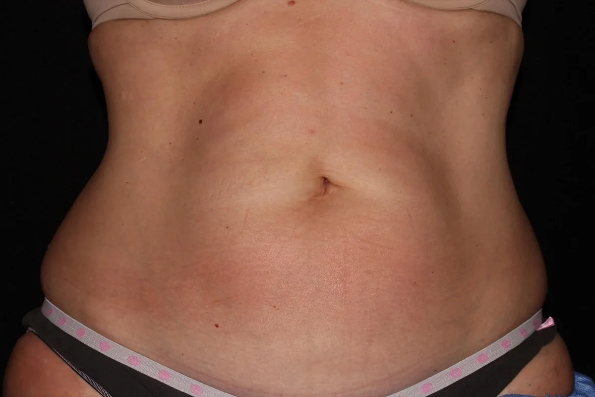 Middle-aged woman before CoolSculpting