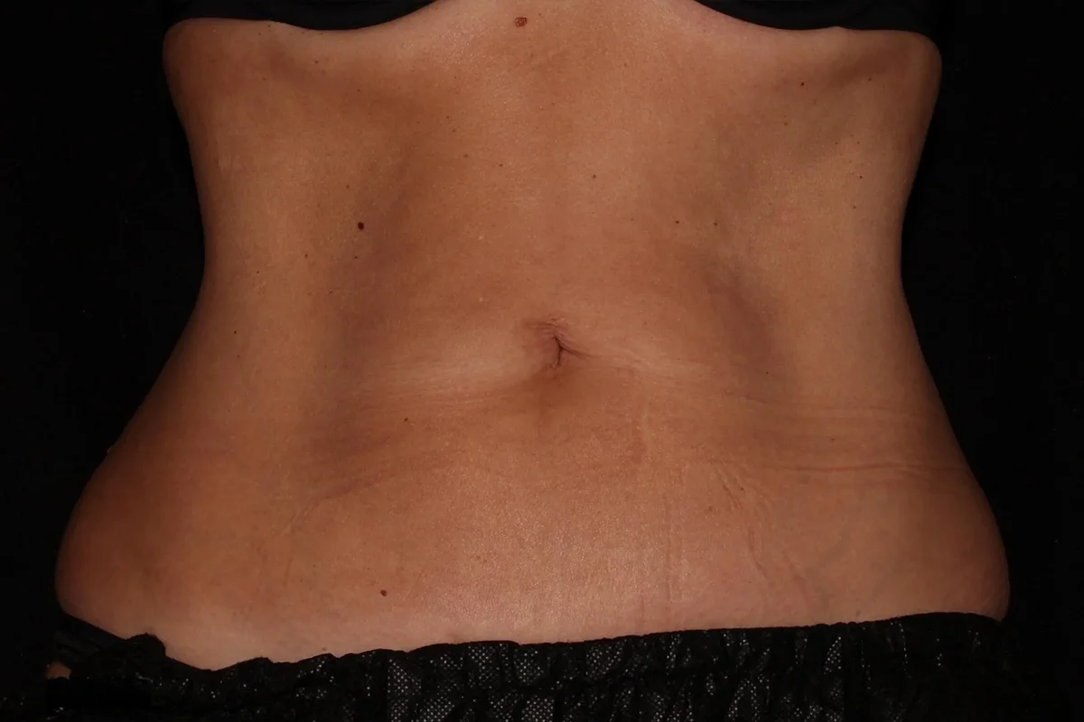 Middle-aged woman after CoolSculpting