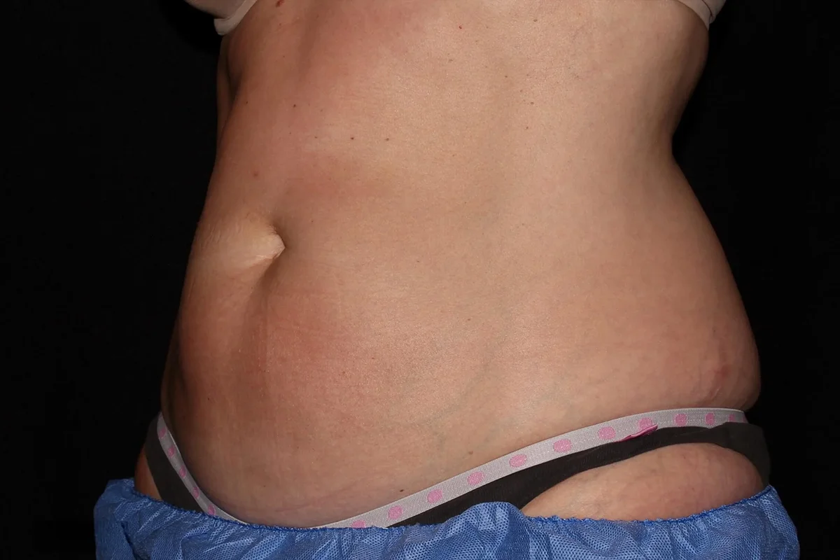 Middle-aged woman before CoolSculpting