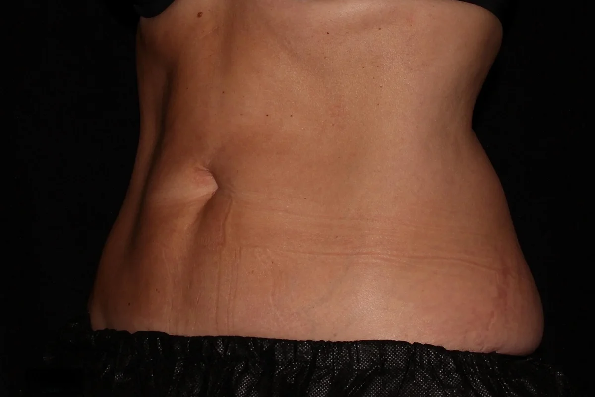 Middle-aged woman after CoolSculpting