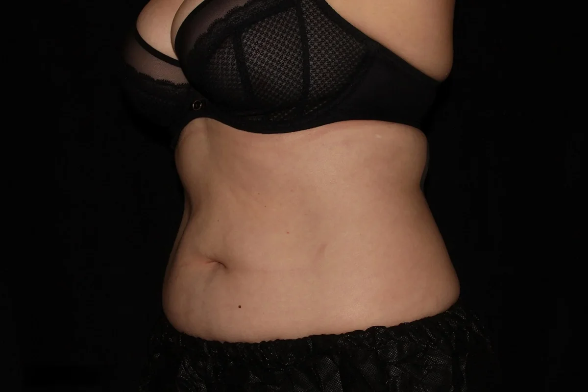 Middle-aged woman before CoolSculpting