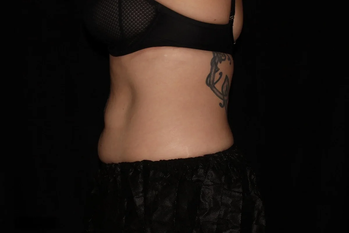 Middle-aged woman before CoolSculpting