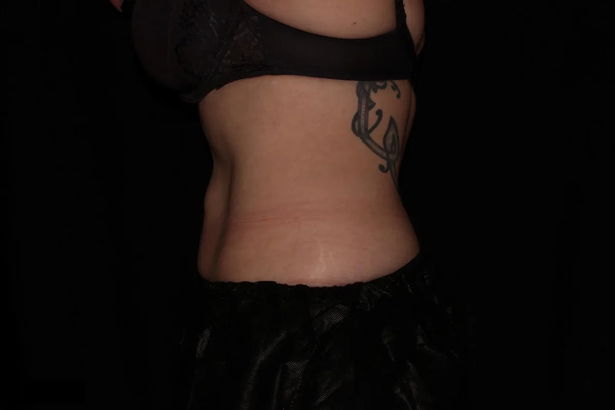 Middle-aged woman after CoolSculpting