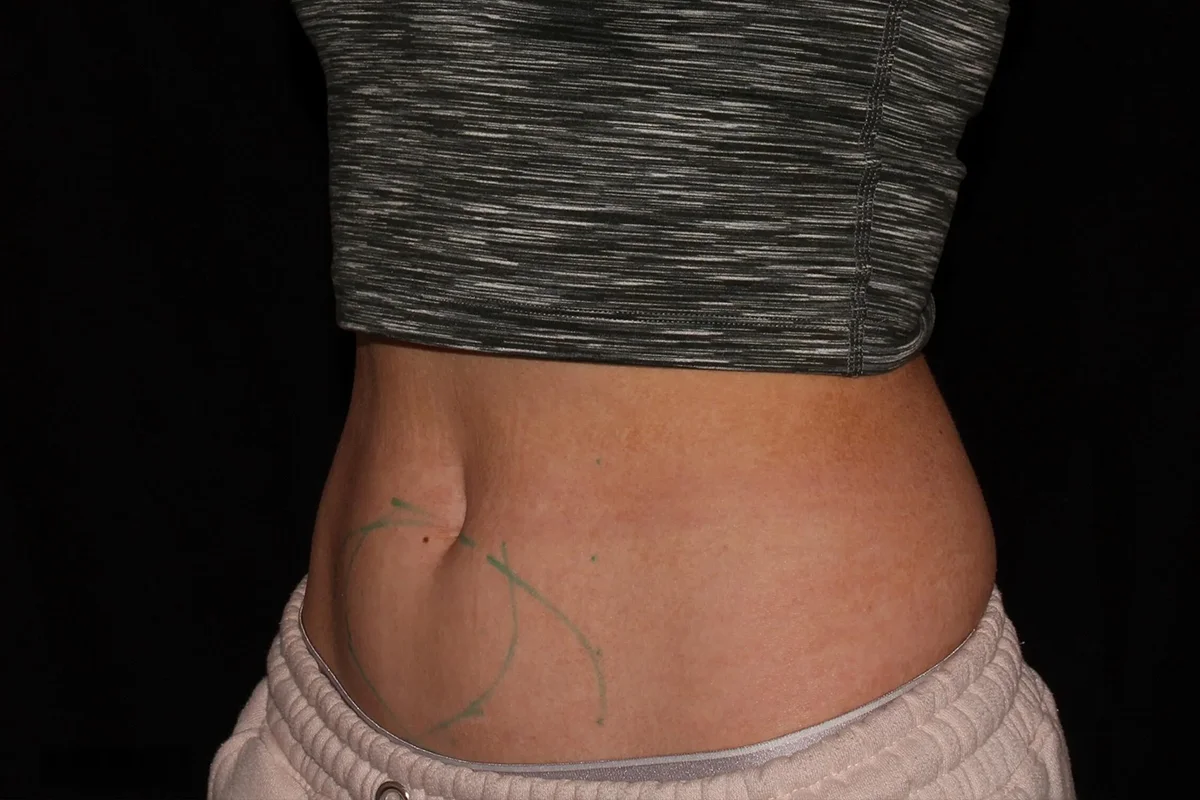 Middle-aged woman before CoolSculpting