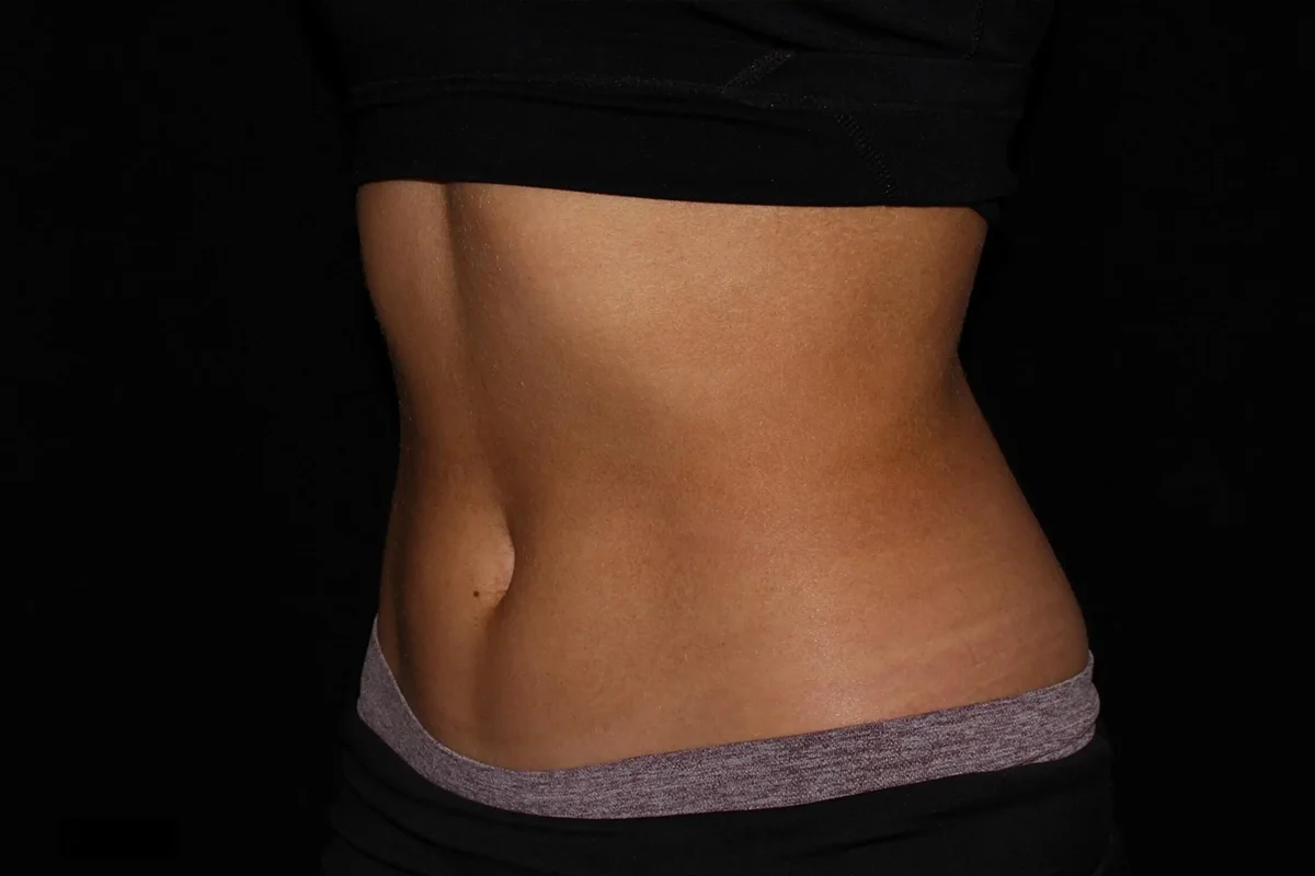 Middle-aged woman after CoolSculpting