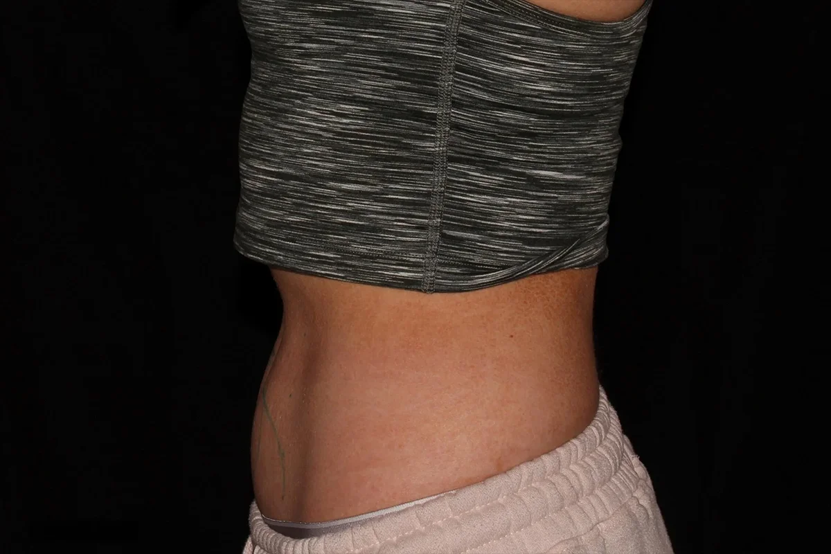 Middle-aged woman before CoolSculpting