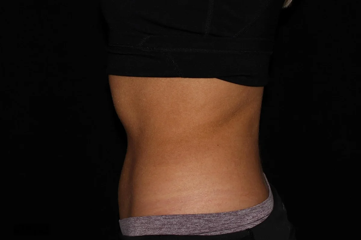 Middle-aged woman after CoolSculpting