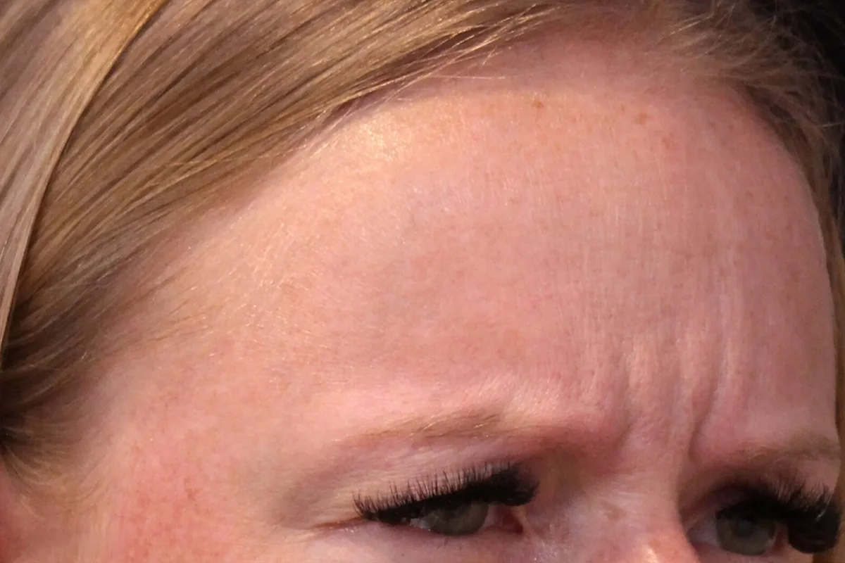 Young woman before Botox