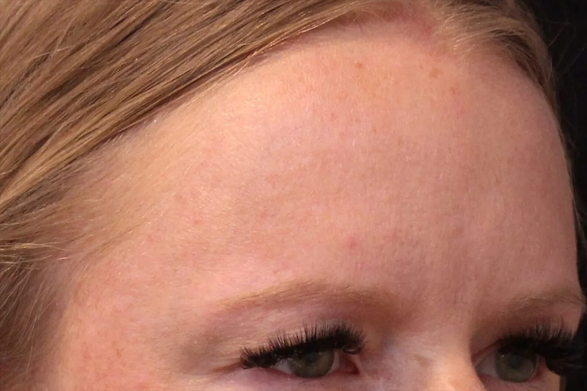 Young woman after Botox