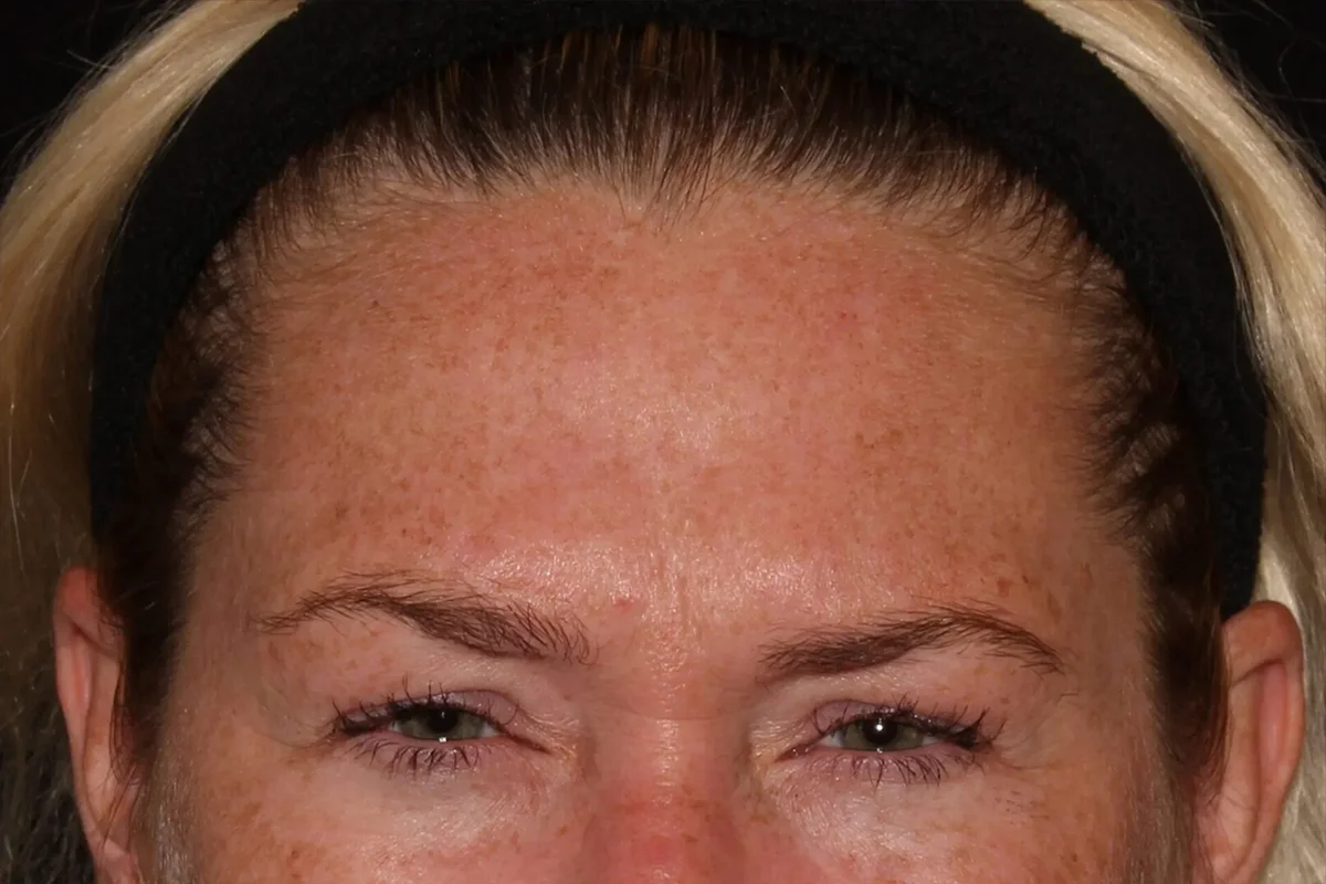 Middle-aged woman before Botox