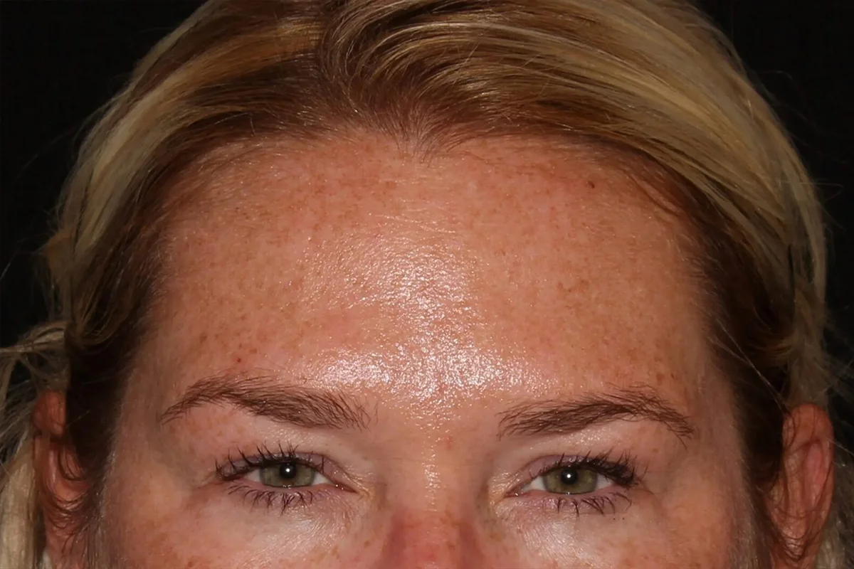 Middle-aged woman after Botox