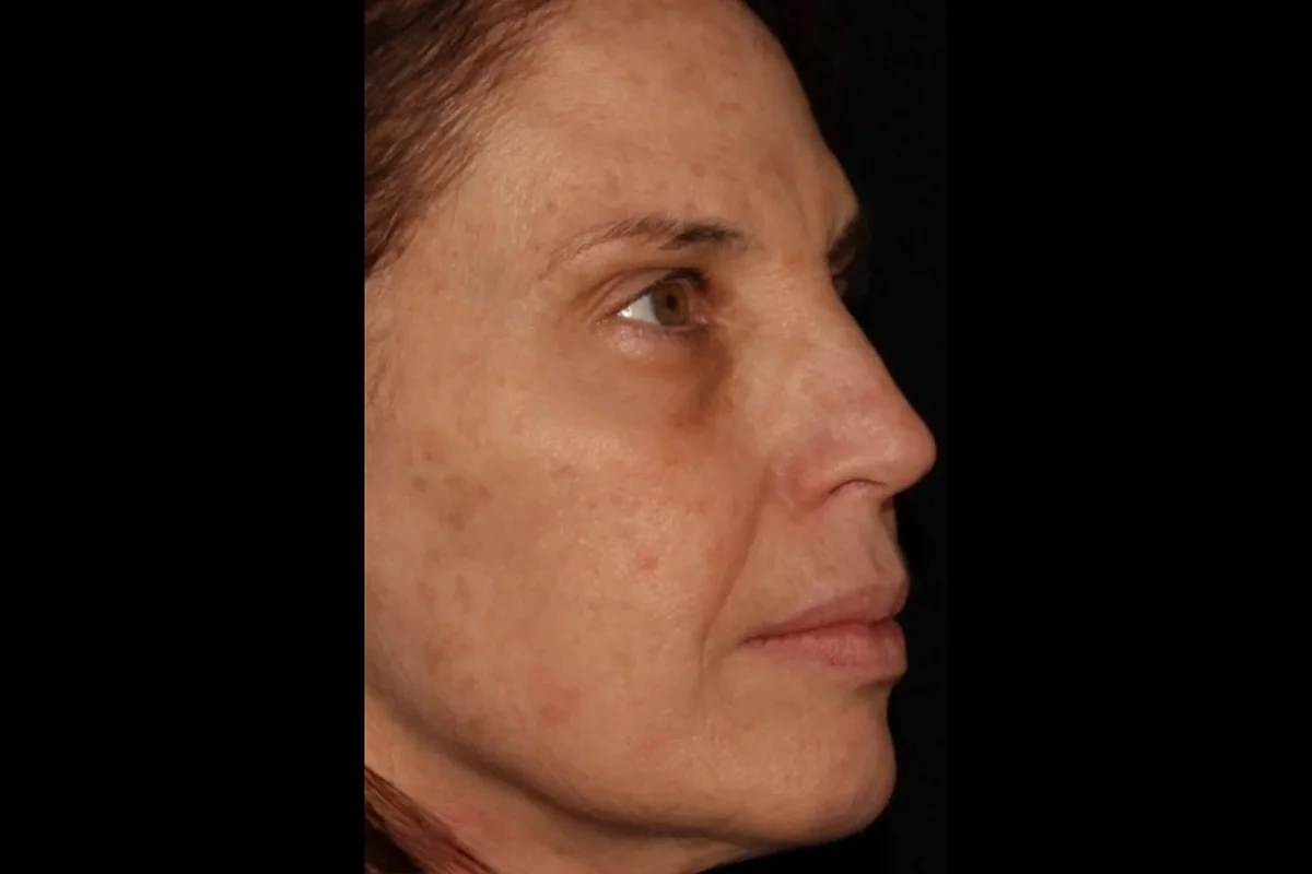 Middle-aged woman before Botox and Chemical Peel
