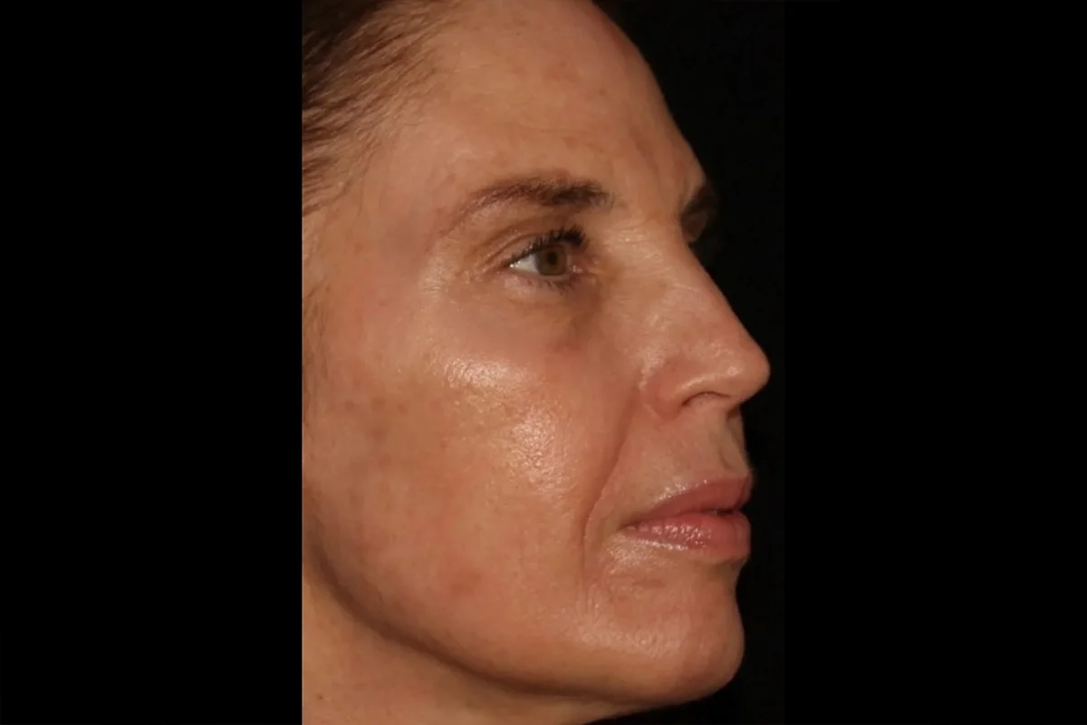 Middle-aged woman after Botox and Chemical Peel