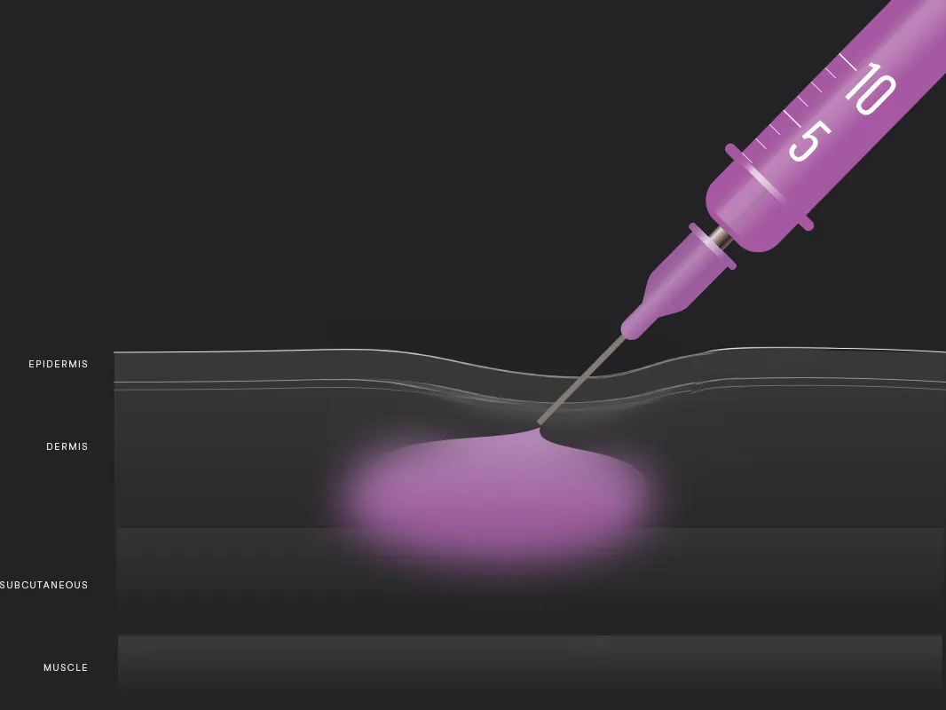 Illustration of skin that is labeled and being injected by a syringe of RHA filler. 