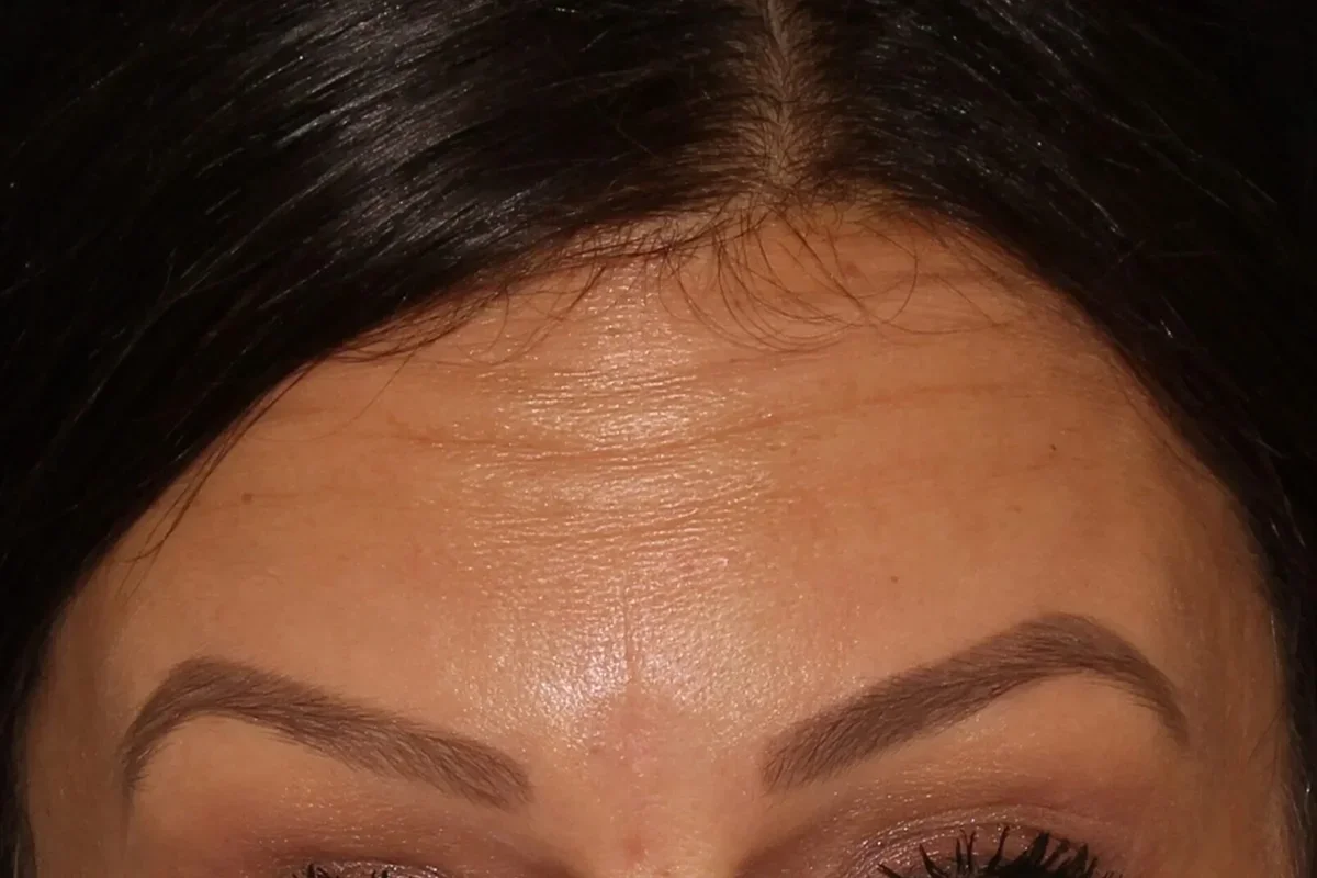 Middle-aged woman before Botox