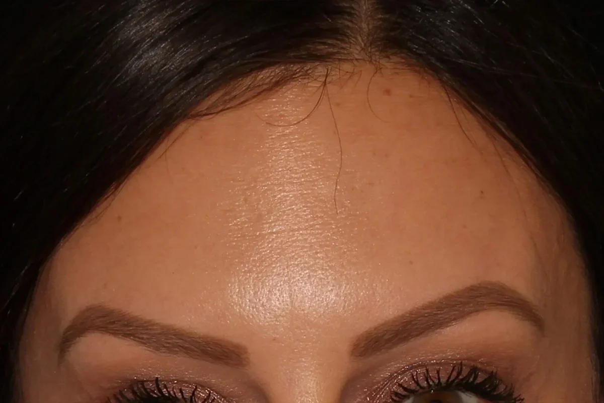Middle-aged woman after Botox