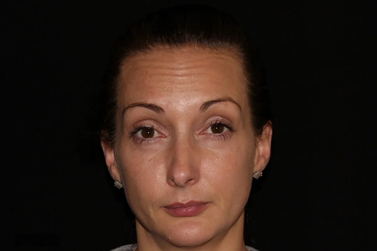 Middle-aged woman before Botox