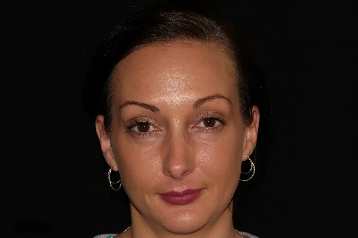 Middle-aged woman after Botox